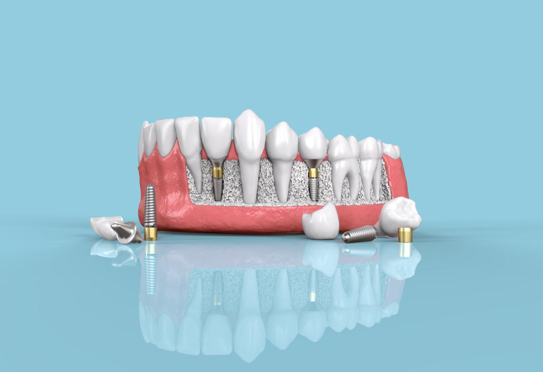 Dental Implants Burien, WA